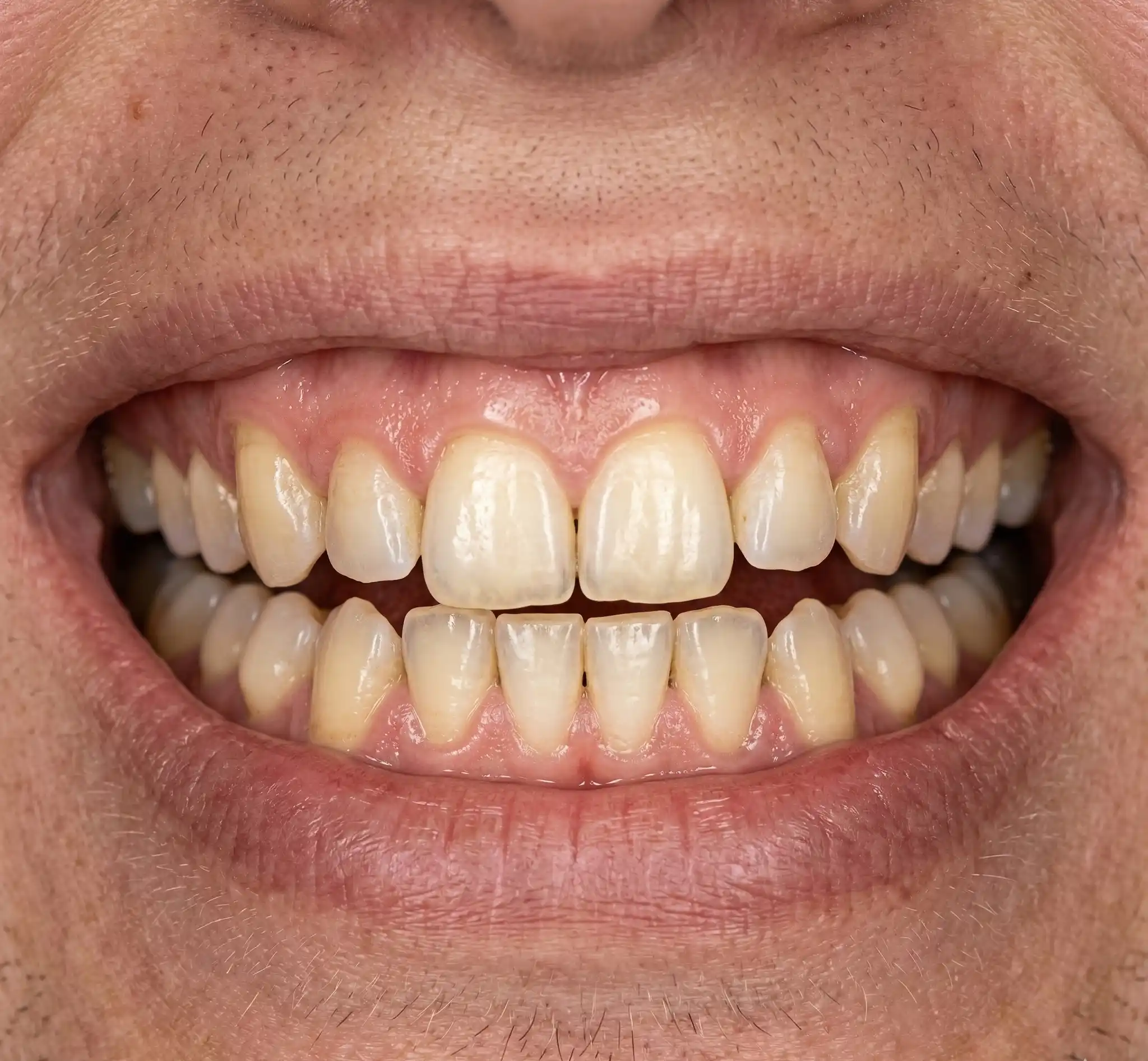 Estetski Zahvat - Prije